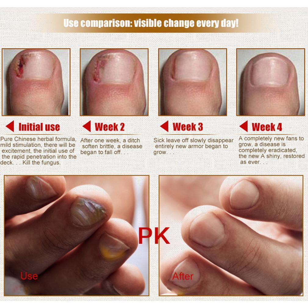 Nail Repair Cream