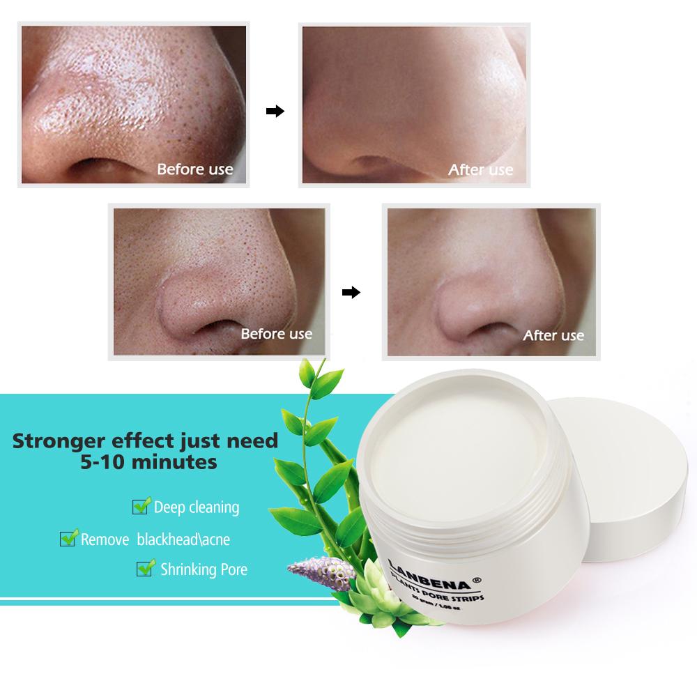 Blackhead Acne Pore Peel Mask