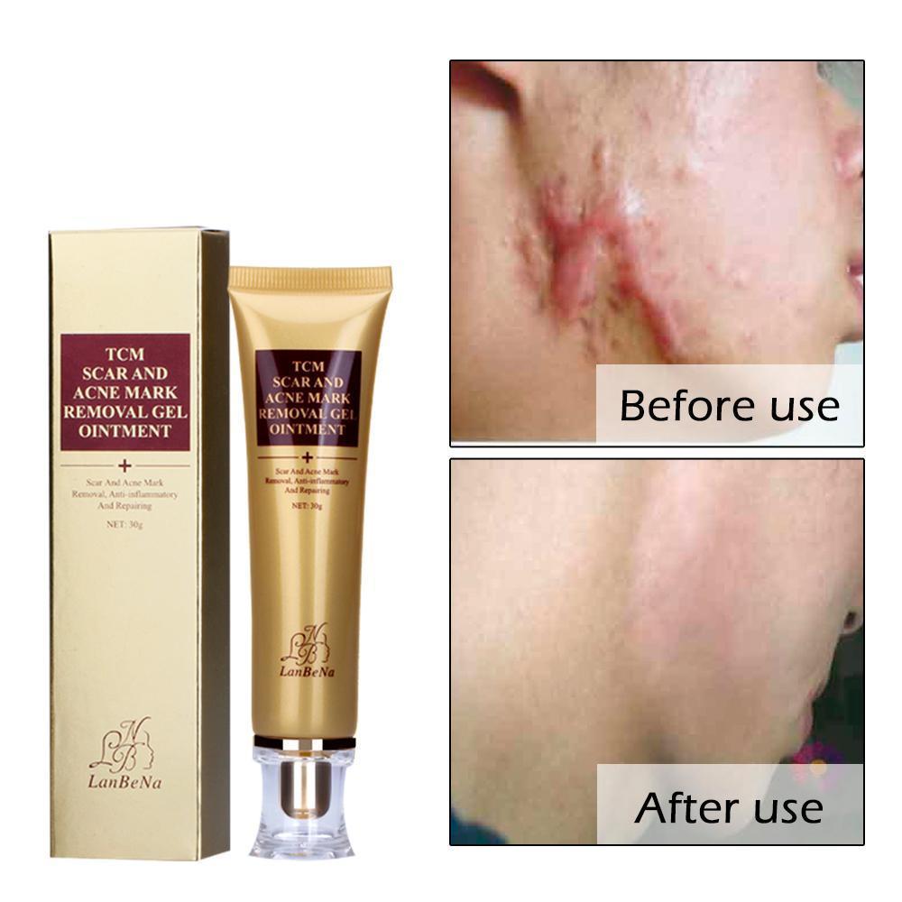Scar Remover Serum - Acne Scars & Stretch Marks