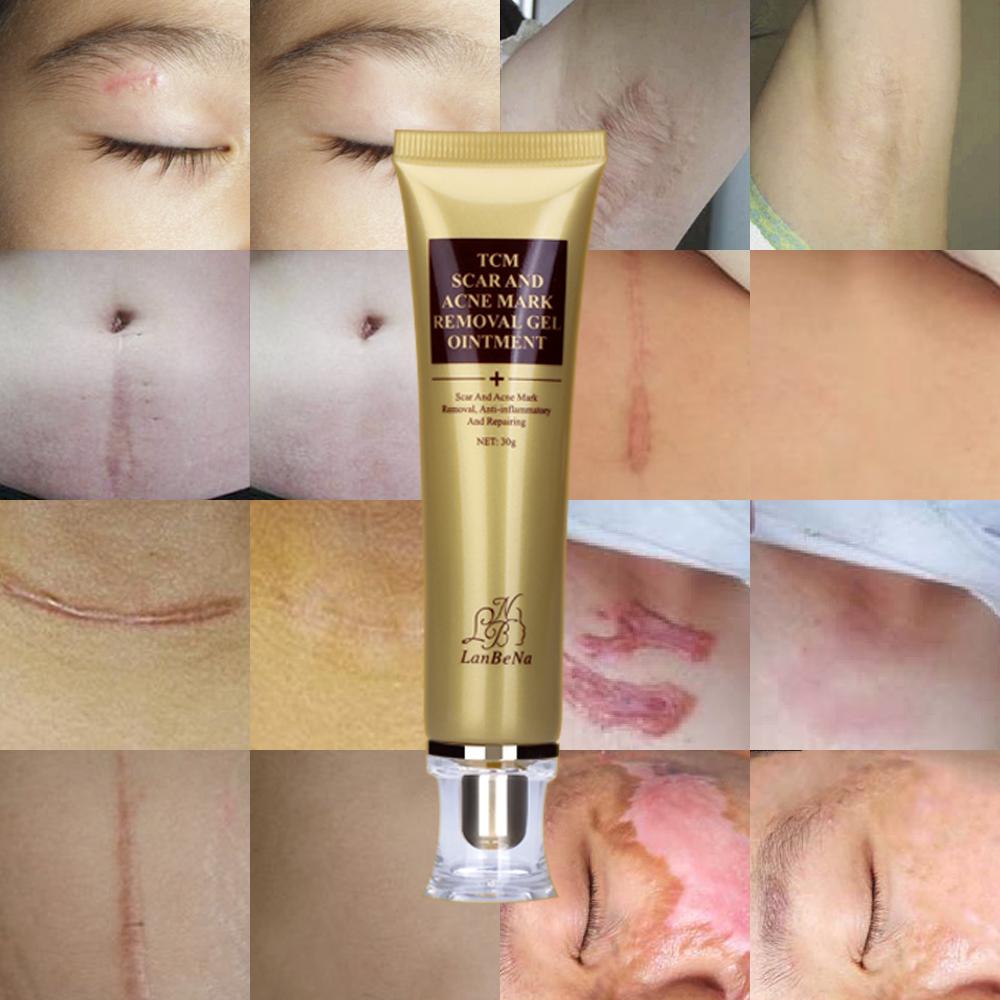 Scar Remover Serum - Acne Scars & Stretch Marks